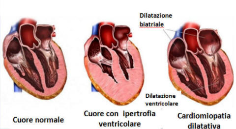 La Cardiomiopatia Ipertrofica Il Cuore Ingrossato