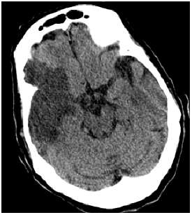 area ictale, evidenziabile sulla sinistra dell'encefalo come area più scura, ipodensa