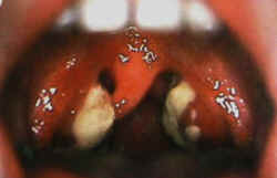 Mal di gola persistente mononucleosi