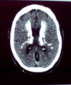 Immagine TAC encefalo di una nostra paziente affetta da sindrome di Fahr, scambiata per ictus, qui le lesioni dei nuclei della base sono calcificazioni.