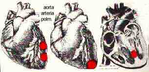 Secondo la zona colpita, si parla di infarto anteriore (primo a sinistra), infarto della punta (centro) e infarto del setto, allorch la zona colpita  il setto interventricolare