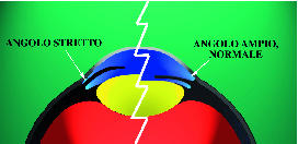 glaucoma_aperto.jpg (11384 byte)