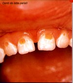 Denti da latte cariati.