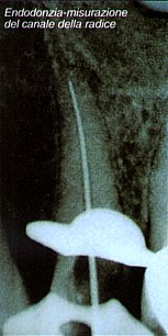 Endodonzia-misurazione del canale della radice.