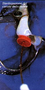 Endodonzia-sterilizzazione del canale della radice.